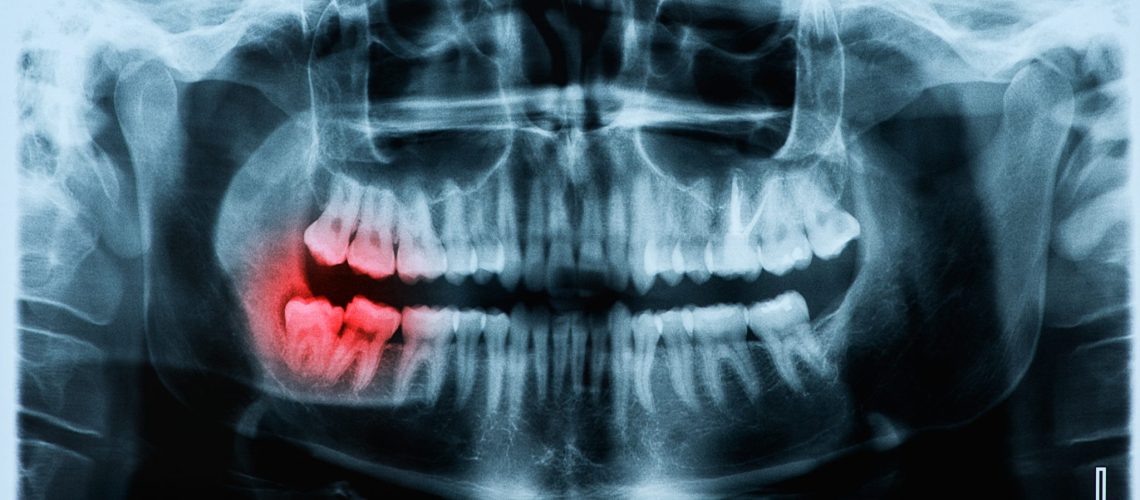 Panoramic x-ray image of teeth and mouth with wisdom teeth